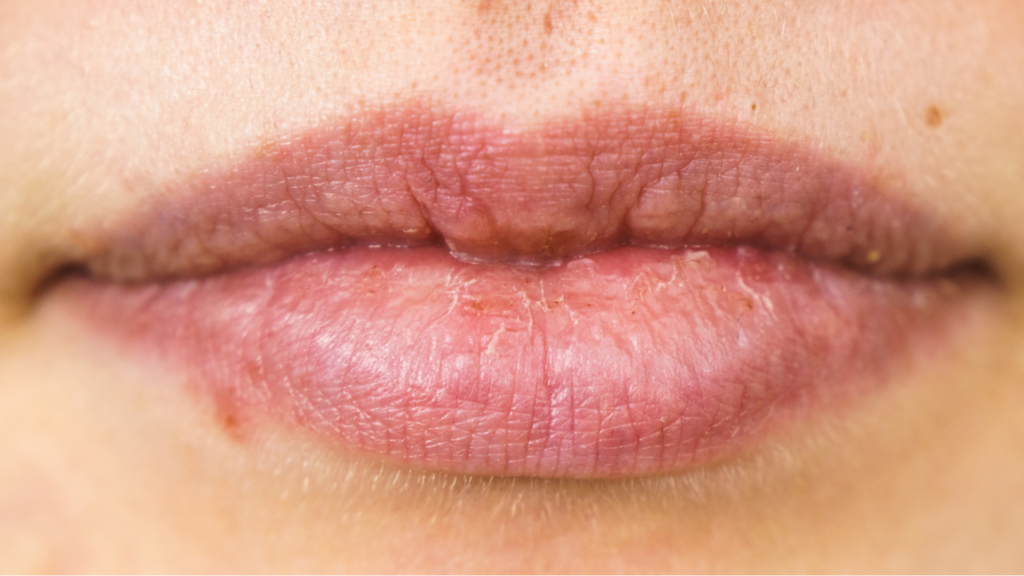 Close up of dry, chapped lips